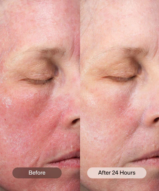 CMT Post-Procedure Cream®