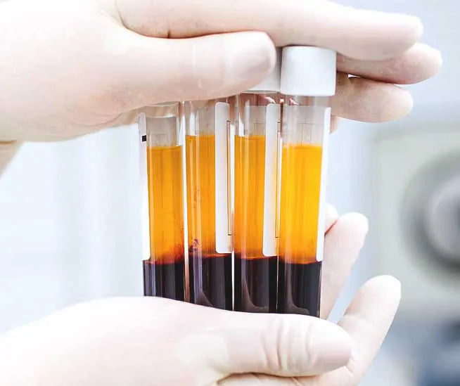 PRP (Platelet Rich Plasma)
